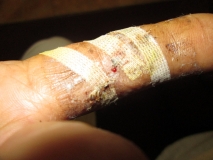 War wound 03