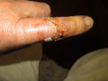 War wound 04