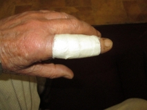 War wound 05
