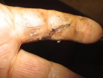 War wound 07