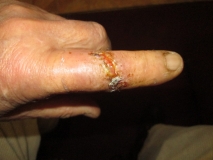 War wound 06