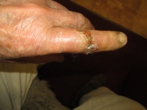 War wound 09