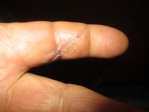 Healing war wound 04
