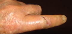 Healing war wound 03