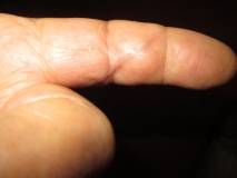 Healing war wound 05