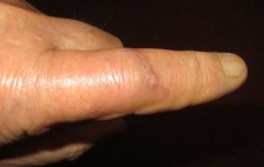 Healing war wound 06