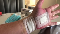 Carpal Tunnel surgery