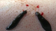 leech_therapy