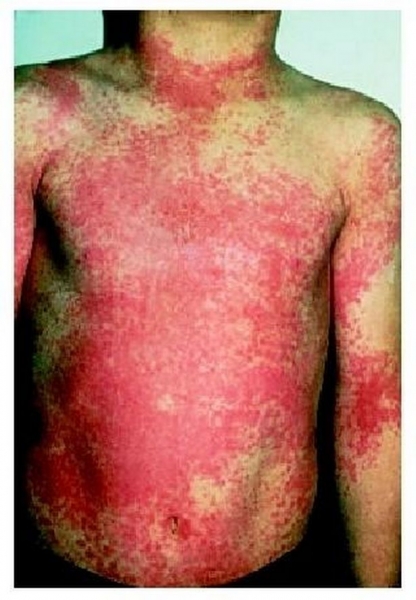 Scarlet-fever-body