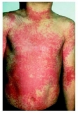 Scarlet-fever-body