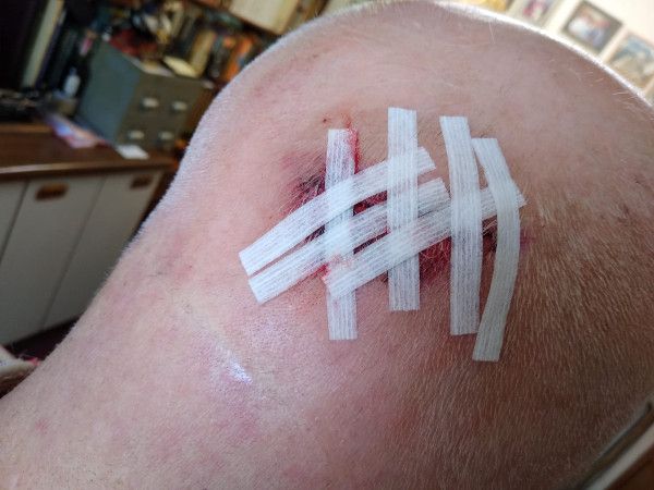 Cut on head with steri strips