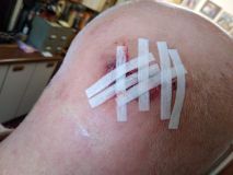 Cut on head with steri strips