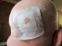 Cut on head a week later