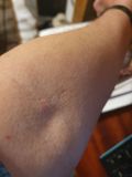 Left Arm