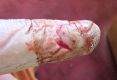 Cut finger 120426