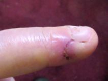 Cut finger 140426